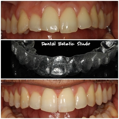 estetska ortodoncija